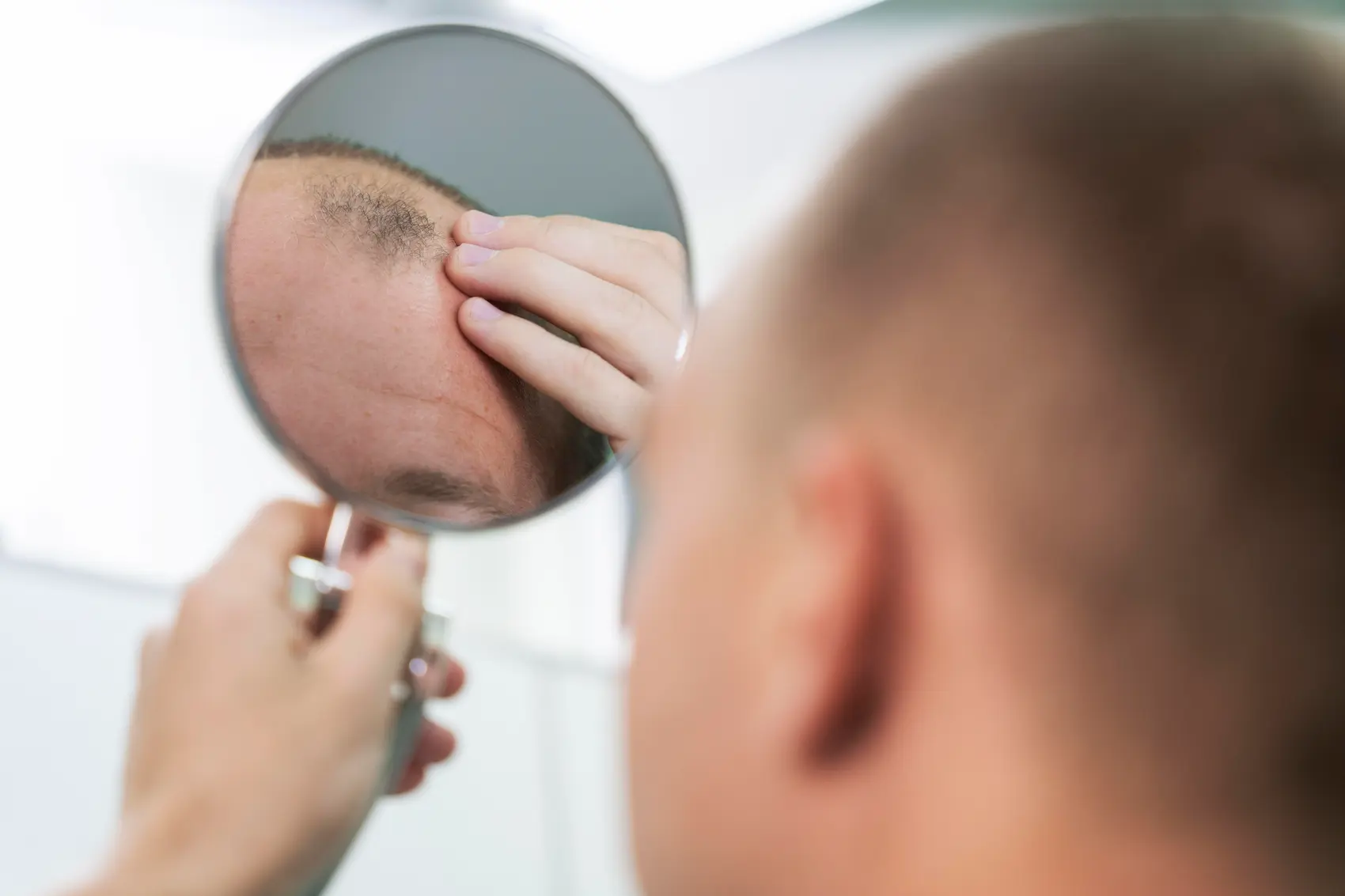 causas de la alopecia